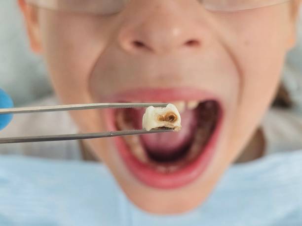 Best Emergency Treatment for Dental Infections or Abscesses in Roosevelt Gardens, FL